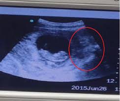 صور مفزعة وجه الشيطان يظهر بجوار جنين فى بطن أمه موقع سيدي