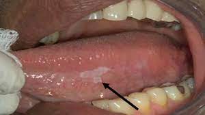 Early warning signs of oral cancer include mouth sores, white or red patches, and tenderness or pain. What Does Mouth Cancer Look Like 5 Pictures Of Mouth Cancer