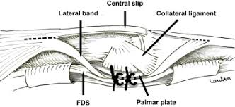 Extensor mechanism will retract, increaseing tension on central slip, if volar plate becomes lax, pip joint hyperextends. Lateral Band Translocation For Swan Neck Deformity Outcomes Of 41 Digits After A Mean Follow Up Of Eight Years Sciencedirect