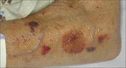 Almost like someone poked you with a red ink pen. Skin Disorders In Older Adults Vascular Lymphatic And Purpuric Dermatitides Part 1