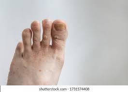 Image result for Pitting nails feet