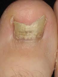 Nails loosen and separate from the bed when fungus grows under your nails. Onychomycosis Wikipedia