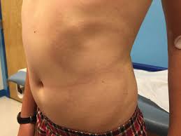 Chest muscle strain which is also known by the name of pectoral muscle strain. A 13 Year Old Boy Presents With Red Annular Rash On Torso Thighs
