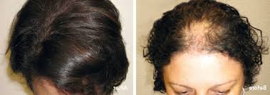 Pendant la grossesse la femme vit des modifications hormonales qui ont pour effet d'empêcher la perte du cheveu. Ù…Ø±Ø¹Ø¨ Ø¹Ø§ØµÙØ© Ø¹Ù†ÙˆØ§Ù† ØªÙØ³ÙŠØ±ÙŠ Perte De Cheveux Cause Femme Sjvbca Org