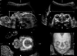 Three Dimensional Ultrasound With Maximal Mode Rendering A Novel Technique For The Diagnosis Of Bilateral Or Unilateral Absence Or Hypoplasia Of Nasal Bones In Second Trimester Screening For Down Syndrome Benoit 2005