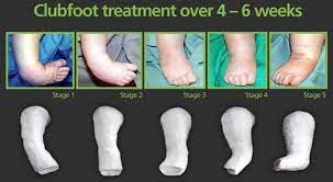 Clubfoot may be associated with a chromosomal abnormality, as a part of a syndrome (collection of other birth defects). Ponseti Method For Clubfoot Treatment