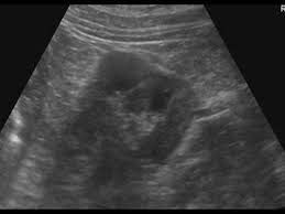 3 it can sometimes mimic a kidney neoplasm and therefore considered a renal. Urinary Tract And Male Reproductive System 2 1 Kidney And Ureter Case 2 1 2 Benign Renal Tumors Ultrasound Cases