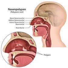 Nasenpolypen Polypen Gesundheitsportal