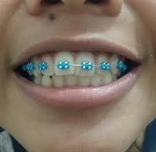 Mempunyai warna keramik mungkin adalah salah satu. Demi Penampilan Pasang Kawat Gigi Sakit Ditahan