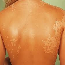 Learn about pityriasis alba including what pityriasis alba look like. Pityriasis Versicolor Alba Altmeyers Enzyklopadie Fachbereich Dermatologie