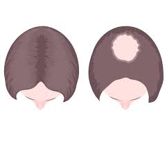 Other vitamin deficiency that cause hair loss in children, men & women. Alopecia Overview About The Different Forms Of Hair Loss