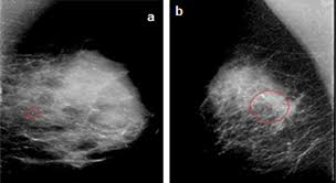 Image result for Mammogram Interpretation