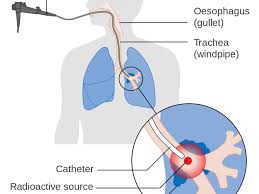 What are the early signs of lung cancer? Treating Lung Cancer Symptoms Irish Cancer Society