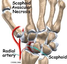 Image result for Scaphoid Fracture Signs