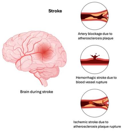 Types of stroke. A schematic representation of the brain during stroke... |  Download Scientific Diagram