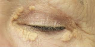 Image result for xanthelasma of eyelid