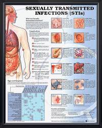 sexually transmitted infections chart 20x26 family nurse