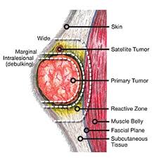 If cancer cells are present, this will influence decisions about treatments such as additional surgery and radiation. Fundamentals Of Surgical Oncology In Small Animals Today S Veterinary Practice