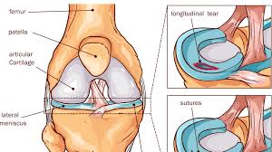 Muscles of the leg muscle origin insertion nerve supply tibialis anterior distal part of the lateral condyle of the tibia, lateral surface of the proximal half of the shaft of the tibia, adjacent interosseous membrane, overlying fascia near the condyle of the tibia, and intermuscular septum between it and the extensor digitorum longus… Meniscus Vs Cartilage Tear Of The Knee