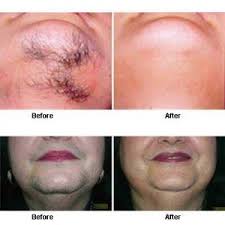 Laser treatment reduces hair problems in pcos women. Darkcolorhair Pcos Hair Growth