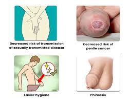 Image result for Phimosis