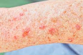 It might look skin coloured, waxy, like a scar or thickened area of skin that's very slowly getting bigger. Skin Cancer Symptoms Mclean Woodbridge Va Skin Laser Dermatology Center