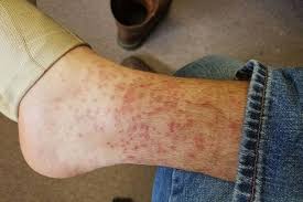 See full list on wikihow.com How Long Do Chiggers Live On Your Skin Skin Care Geeks