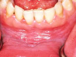 Canker sores look like ulcers with a grey, yellow, or white center and a flat, red border. Red Spots On Roof Of Mouth Causes And Other Symptoms