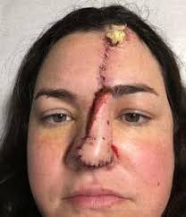 Image result for skin cancer on nose pimple