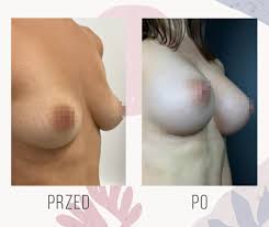 Powiększanie piersi implantami, Operacja biustu → Warszawa