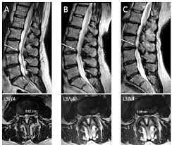 Image result for Low Back Imaging