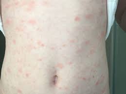 In zona pe care sunt aceste pete pielea este mai uscata. ErupÈ›iile Cutanate Un Nou Simptom Al InfecÈ›iei Cu Noul Coronavirus Cum Le RecunoaÈ™teÈ›i Foto Stirileprotv Ro