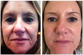 Results may vary among patients. Best Dysport In Dallas At Advanced Skin Fitness Medspa
