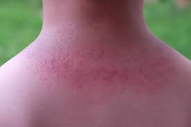 I also have random hives that come out of nowhere so i feel the frustration. How Long Does It Take For Hives To Go Away