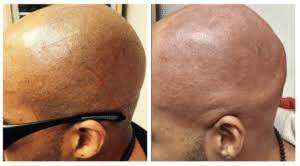 Electrolysis and laser hair removal are supposed to be permanent in effect, as they destroy the hair's root. Laser Hair Removal For Men In Nyc Hair Reduction In Nyc