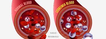 For example, if the cancer spreads to the central nervous system, it can cause headaches,. Blood Cancer Leukemia Causes Symptoms And Treatment Netmeds
