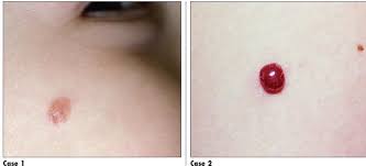 Image result for Spitz Nevus