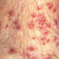 Image result for Trombicula autumnalis bites