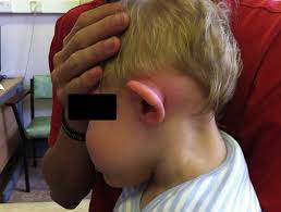 Image result for Mastoiditis
