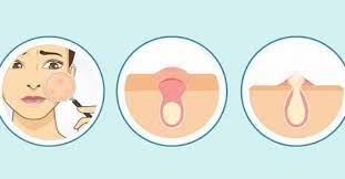 Un bouton sur le pénis est en effet souvent une source d'angoisse. Conseils Se Debarrasser Des Boutons Sous Cutane