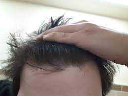 20 M Am I Going Bald Hairline Receding Hair Beauty Skin Deals Me Fashion Love Cute Style Women M Hair Loss Remedies Celebrity Hair Colors Hairline