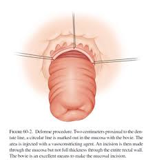 Image result for Rectal prolapse