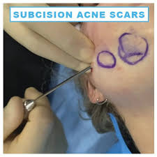 Mobility in my joints became better, and they stopped aching. Subcision For Acne Scars Dr Sajjad Rajpar