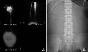 Large Pseudocyst In The Anterior Extraperitoneal Space As A Complication Of Ventriculoperitoneal Shunt Sciencedirect