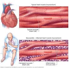 Image result for Myocarditis