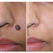 Tahi lalat umum dimiliki oleh semua orang. Cara Menghilangkan Tahi Lalat Yang Menggangu Di Wajah Tanpa Operasi Cacatrik