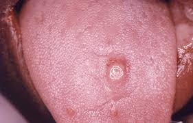 Maybe you would like to learn more about one of these? Syfilis I Mundhulen Pa Laeber Og Tunge Manifestationer Og Symptomer Infektionsmader Behandling