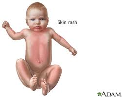 Image result for Rubella