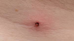 Image result for infected tick bite