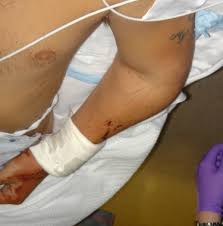 Image result for Radial Head Dislocation